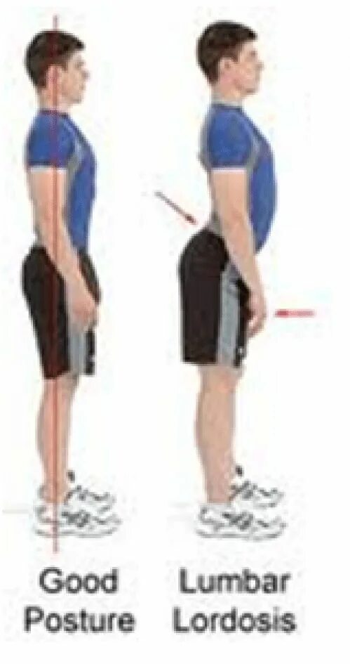 Как исправить лордоз. Типы осанки лордоз кифоз. Поясничный лордоз сглажен. Сглаженный лордоз поясничного отдела упражнения. Гиперлордоз и кифоз.