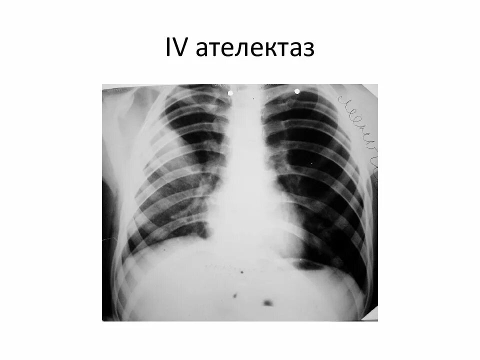 Компрессионный ателектаз легкого рентген. Субтотальный ателектаз легкого. Ателектаз верхней доли рентгенограмма. Центральное зно левого легкого. Ателектаз на рентгене.