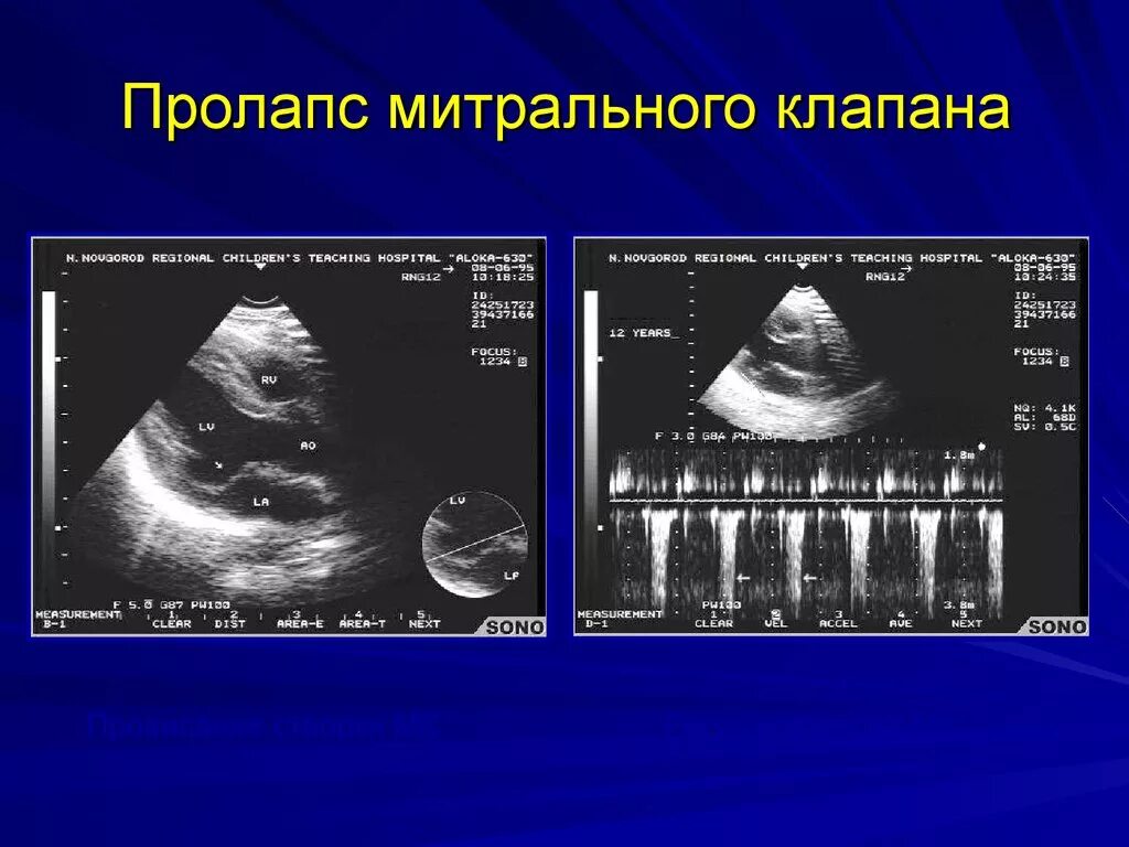 Дегенерация митрального клапана. Пролапс митрального клапана по ЭХОКГ. Пролапс митрального клапана на ЭХОКГ степени. Пролапс митрального клапана эхокардиография. Створки митрального клапана на УЗИ.