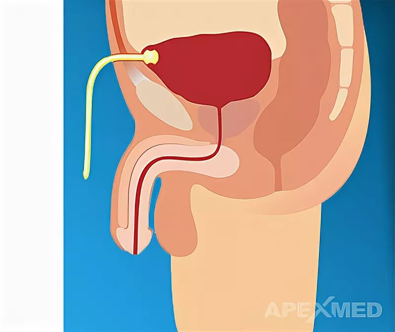 Трубочку в мочевой пузырь. Цистостома мочевого пузыря. Цистостома мочевого пузыря у мужчин. Трубка в мочевом пузыре у мужчины.