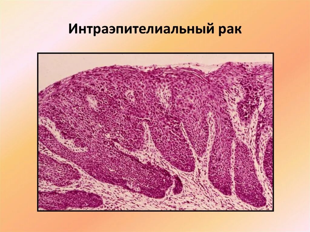 Базальная опухоль. Базальная опухоль