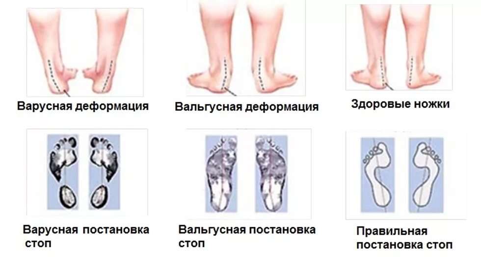 Варусная вальгусная стопа у ребенка. Варусная стопа у детей до года.