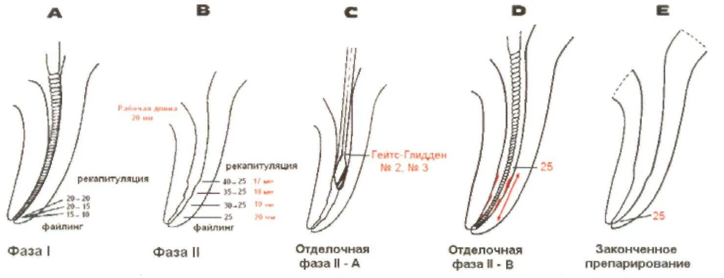 Препарирование корневого канала. Степ Бек техника эндодонтия. Схема методики Step back. Step down техника в эндодонтии. Метод степ Бек в стоматологии.