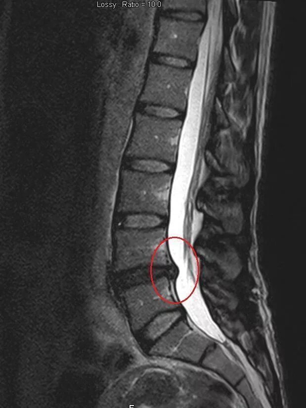 Протрузия диска на уровне l5 s1. Мрт протрузии позвонков l5 s1. Межпозвоночная грыжа l4-l5. Протрузии l4 l5.