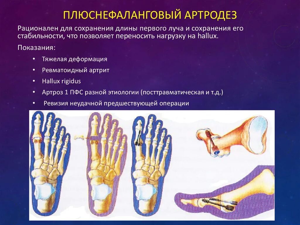 1 Плюснефаланговый сустав ревматоидный артрит. Артрит артроз первого плюснефалангового сустава. Артродез 1 плюснефалангового сустава. Артрит 1 плюснефалангового сустава стопы. Артрит фаланговых суставов