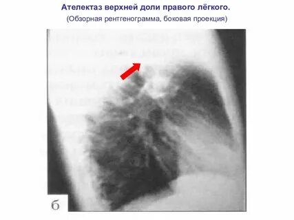 Ателектаз доли легкого