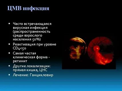 Эта инфекция чаще всего