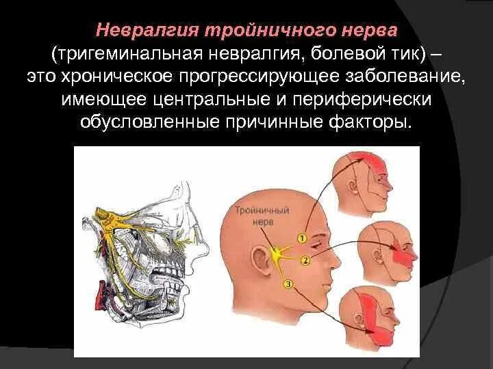 Нейропатия тройничного нерва. Патология тройничного нерва неврология. Воспаление тройничный нерв неврология болезнь. Симптомы поражения тройничного нерва.