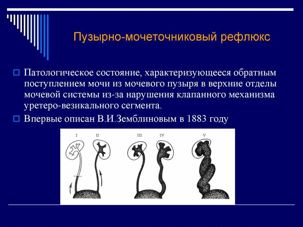Рефлюкс у ребенка форум. Пузырно-ренальный рефлюкс. пузырно мочеточечниковый рефлекс. пузирний мочеточний рефлукс. пузырно-мочеточниковый пузырно-мочеточниковый рефлюкс.