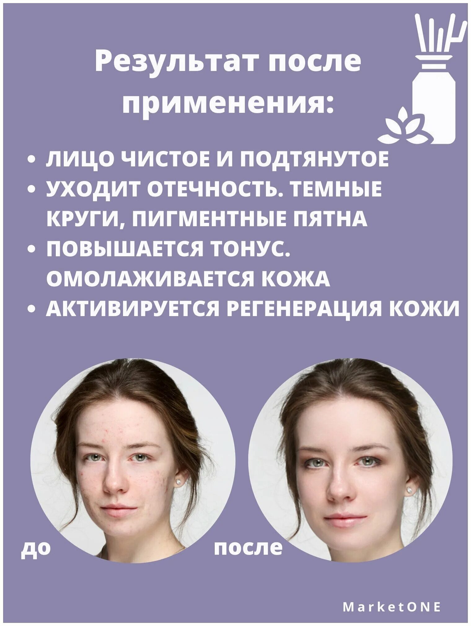 Дарсонваль для лица до и после. Дарсонваль biolift4 118. Дарсонваль для лица. Дарсонваль для лица эффект. Дарсонваль для лица эффект омоложения.