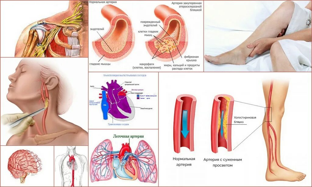 Артерий атеросклероз латынь. Нестенозирующий атеросклероз магистральных артерий головы. Нестенозирующий атеросклероз нижних. Атеросклероз сосудов бца. Атеросклероз сосудов нижних конечностей, брахиоцефальной системы..