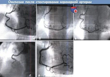 Жизнь после стентирования коронарных сосудов