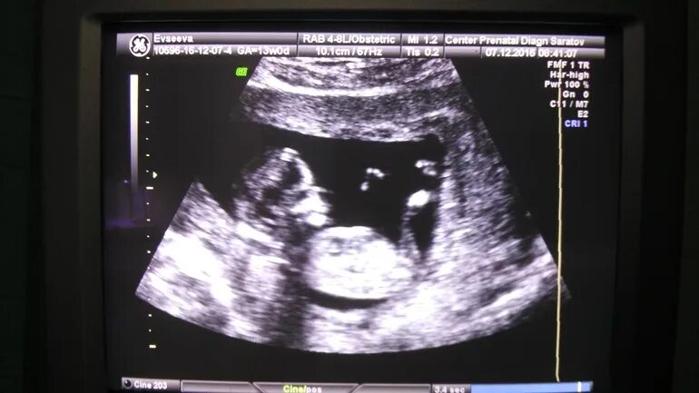 Фото мальчика 12 недель. УЗИ 12-13 недель беременности скрининг. Скрининг мальчика на 12 неделе беременности. Первый скрининг УЗИ 13 недель.