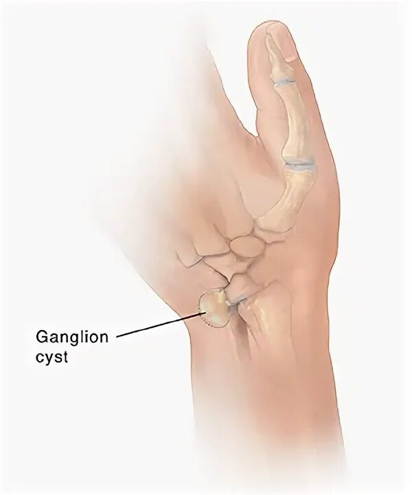 Ганглион лучезапястного сустава. Посттравматический ганглион.