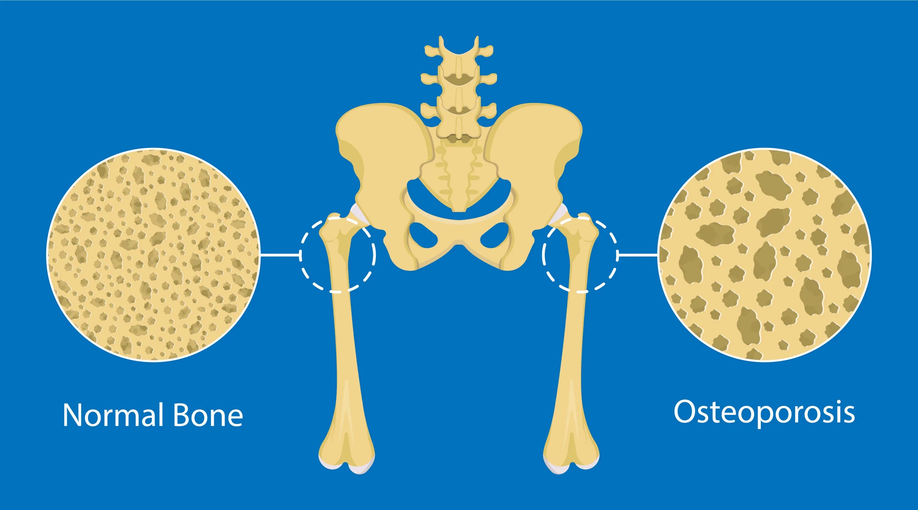 Bone mineral