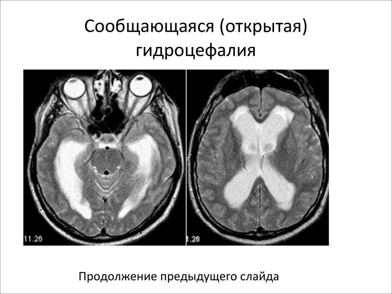 Окклюзионная гидроцефалия мрт. Заместительная наружная гидроцефалия кт. Внутренняя открытая гидроцефалия мрт. Арезорбтивная гидроцефалия головного мозга.