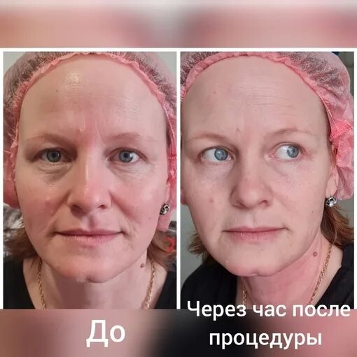Холодная плазма до и после для лица PLASMA LINER