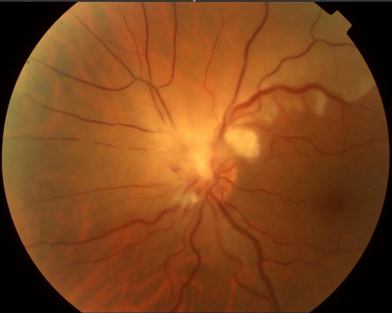 Болезнь глазного дна. Ангиоспазм сетчатки глазное дно. Почечная ретинопатия глазное дно. Тигроидное глазное дно.