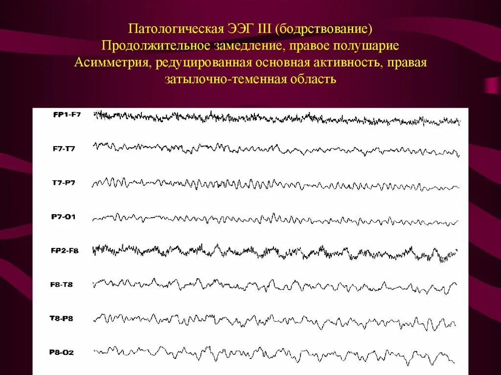 Активность ээг у ребенка что это. Эпилептиформные паттерны на ЭЭГ. Региональная эпилептиформная активность ЭЭГ. Эпилепсия на ЭЭГ. Ритм ЭЭГ эпилепсия.