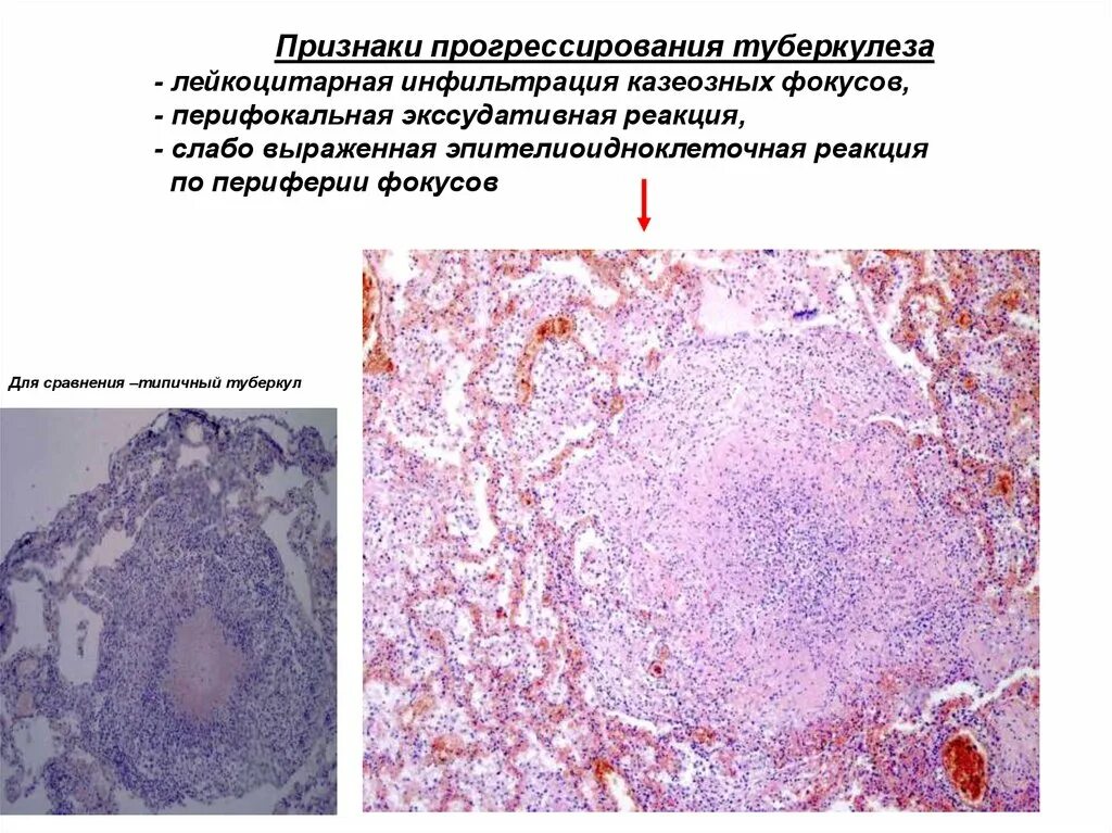 Без перифокальной реакции. Лейкоцитарная инфильтрация гистология. Лейкоцитарная воспалительная инфильтрация. Умеренная местами выраженная лейкоцитарная инфильтрация. Что такое слабо выраженная лейкоцитарная инфильтрация в цитологии.