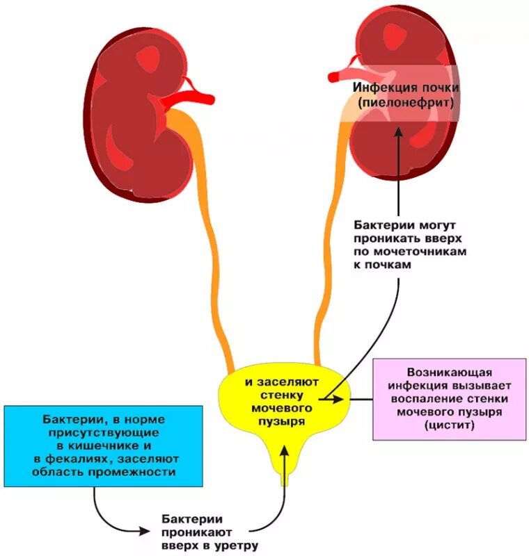 Как болят мочеточники симптомы. Путь распространение инфекции при циститах у детей. Патогенез цистита схема. Заболевания мочевыделительной системы цистит. Пути распространения инфекции хронического пиелонефрита.