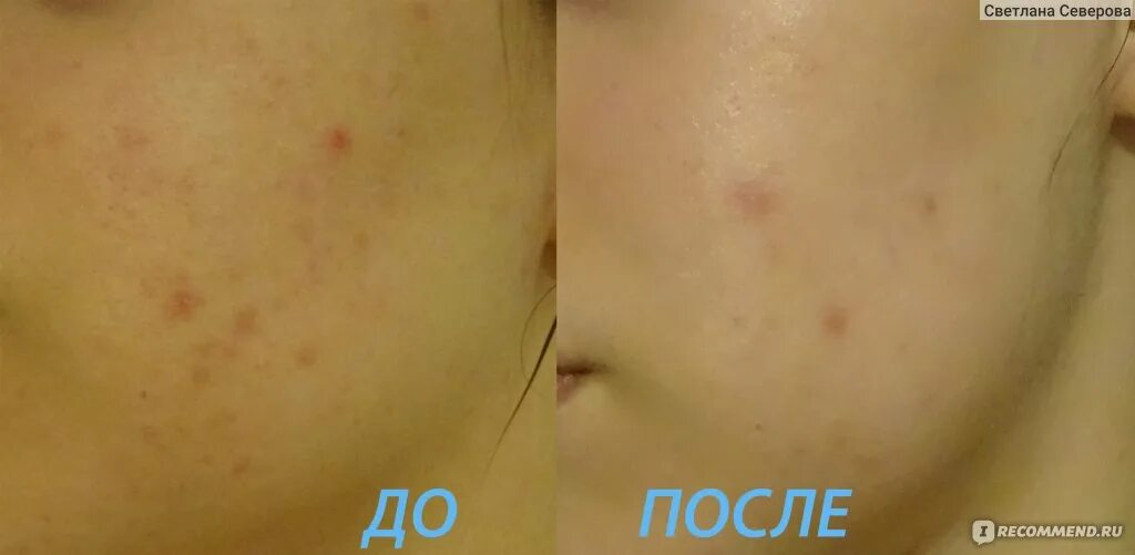 Базирон до и после лицо Дерматотропные средства GALDERMA Базирон АС "Спаситель Базирон АС!!!Фото до и