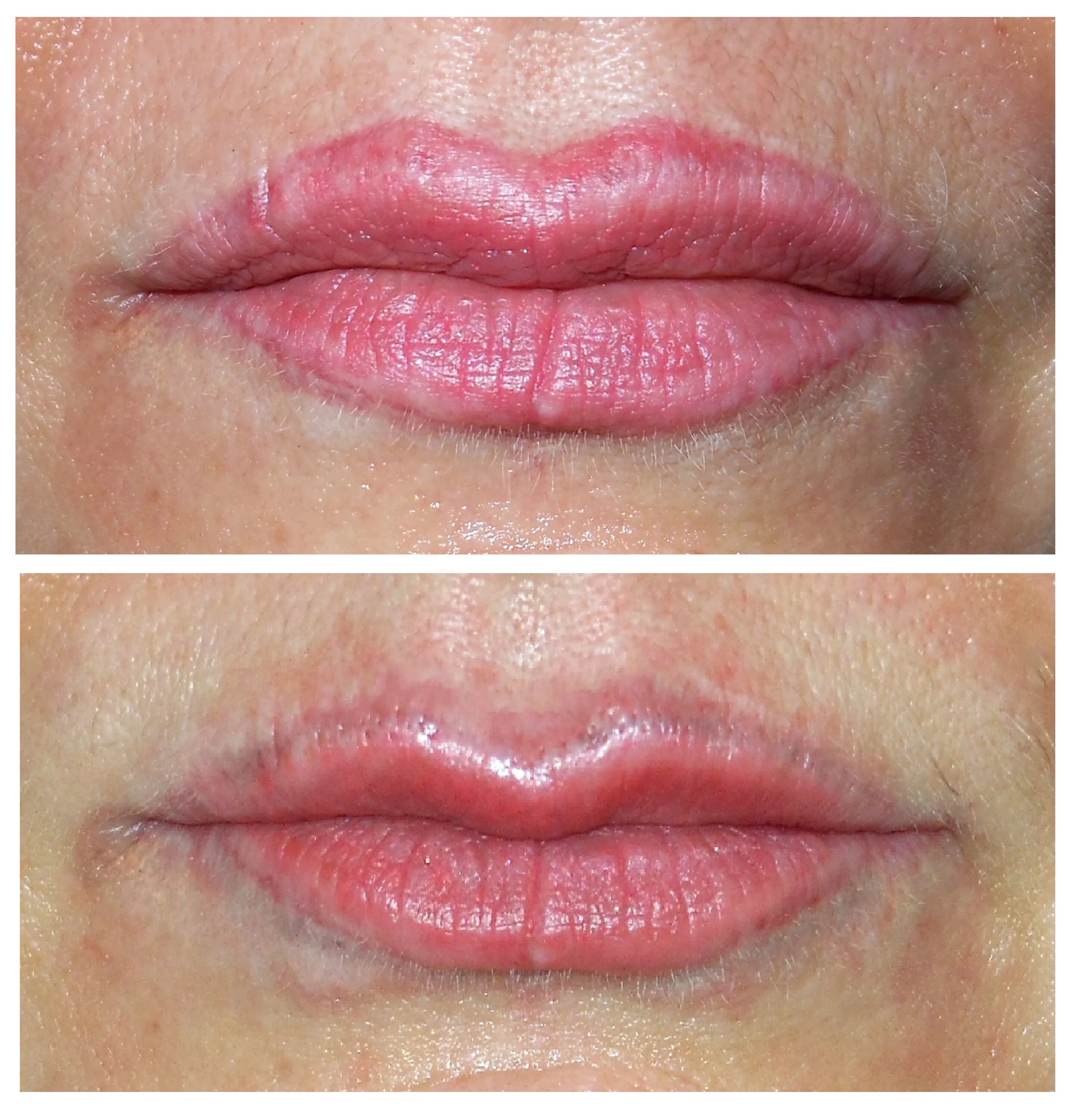 Татуаж губ после лазера. Лазерное удаление татуажа губ. Татуаж губ после лазера. Перманентный макияж губ со шрамом. Лазер губы.