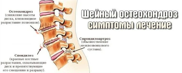 Остеохондроз шейного отдела позвоночника. Хондроз шейного отдела позвоночника. Шейный остеохондроз отде. Шейный остеохондроз симптомы.