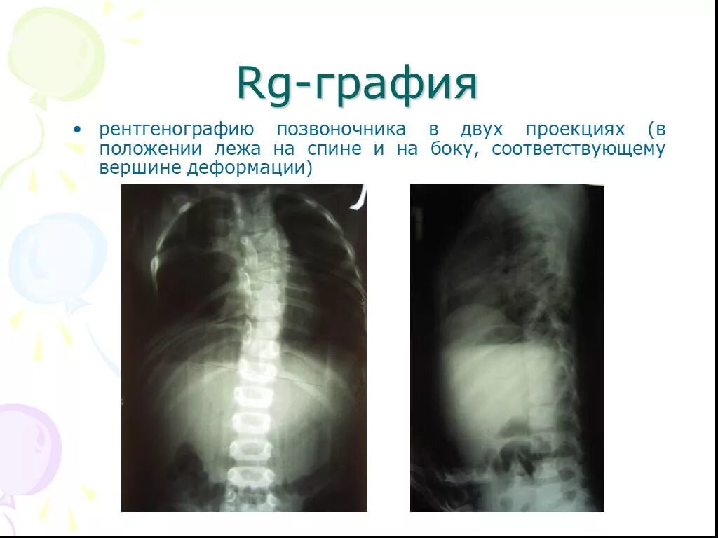 Рентгенография позвоночника в 2 х проекциях. Рентгенография позвоночника в двух проекциях. Рентген позвоночника в 2 проекциях. R графия позвоночника в 2-х проекциях. Рентген поясницы в двух проекциях.