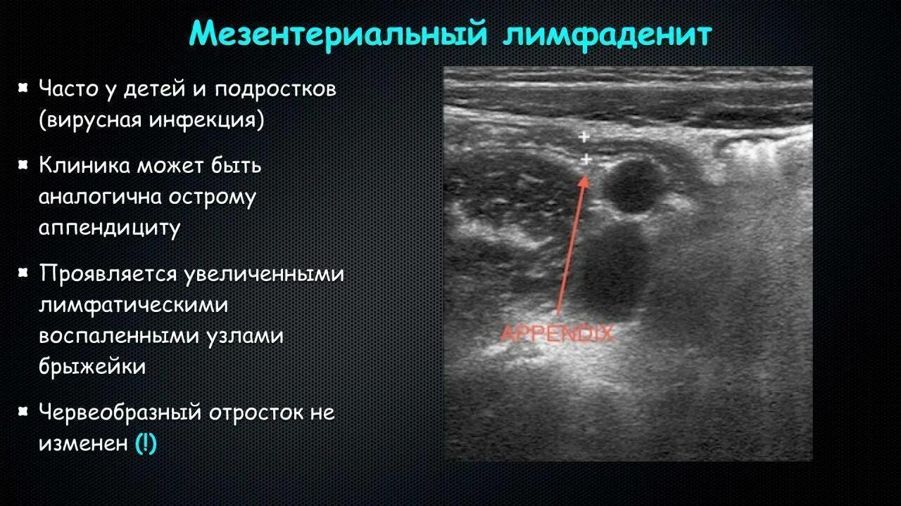 Гиперплазия лимфоузлов у детей. Мезентериальные лимфатические узлы УЗИ. Мезентериальные лимфоузлы на УЗИ протокол. УЗИ лимфатических узлов брюшной полости. Увеличены лимфоузлы в брюшной полости.