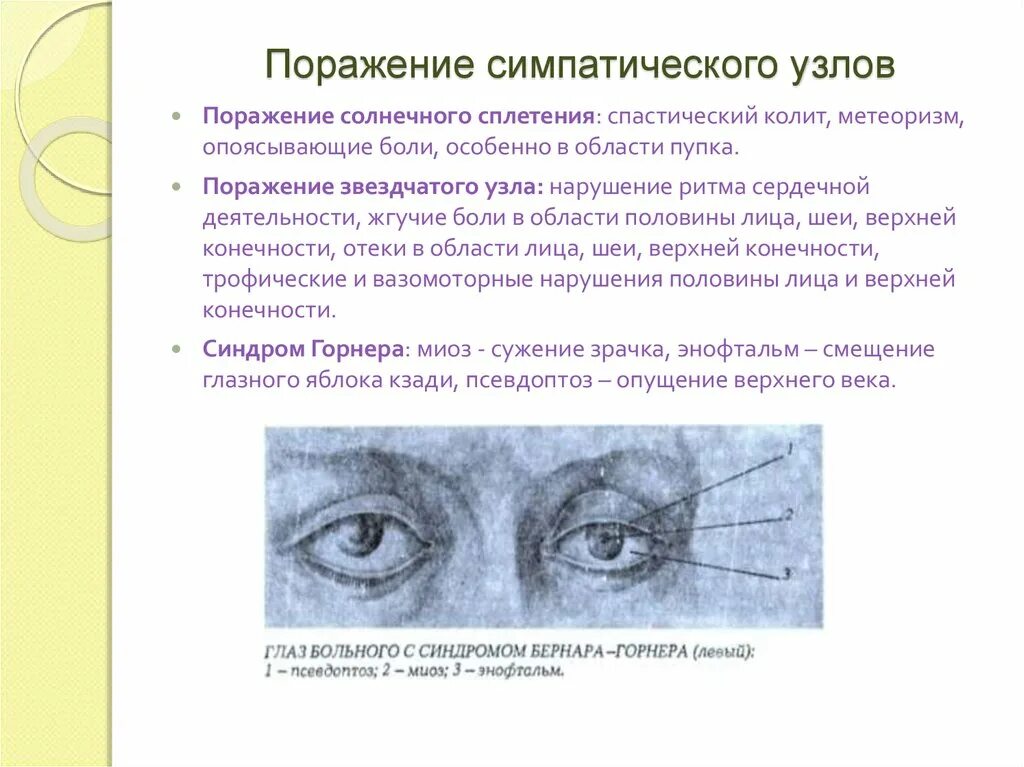 Почему боли в солнечном сплетении. Поражение симпатических узлов. Поражение звездчатого узла. Синдром поражения симпатических узлов. Поражение солнечного сплетения.