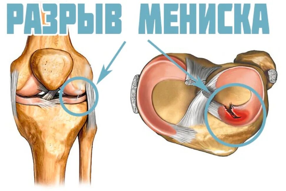 Показать разрыв. Разрыв мениска коленного. Разрыв мениска коленного сустава 3 а. Повреждён мениск коленного сустава симптомы. Разрыв рога мениска коленного сустава.