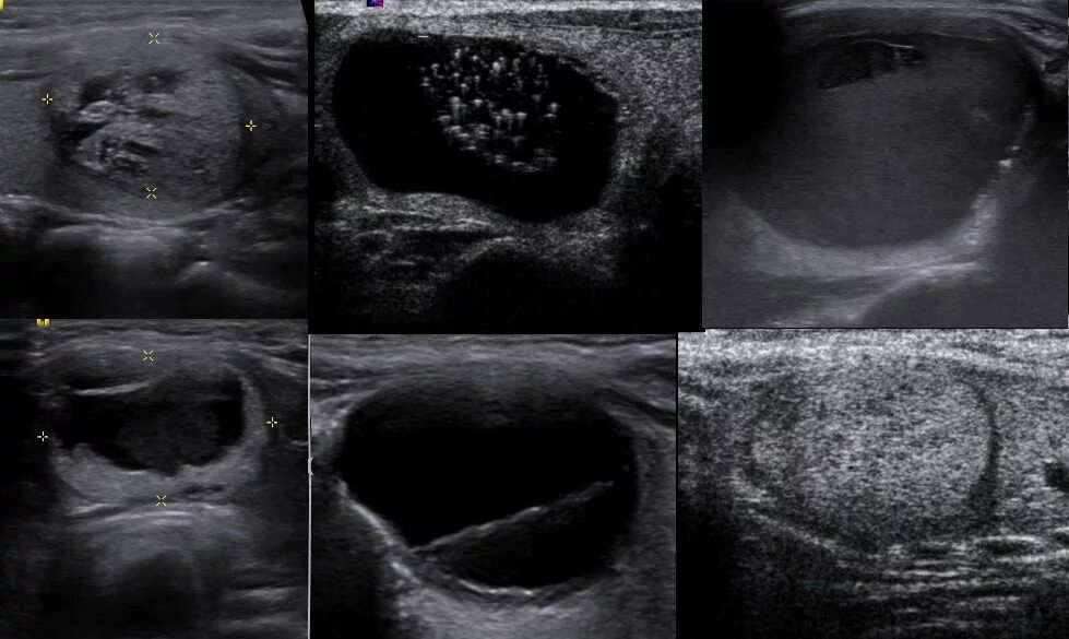 узи щитовидной железы патология. губчатый узел щитовидной железы на узи. кистозные образования в щитовидной железе по узи. фолликулярная аденома щитовидной железы узи. гиперэхогенный узел в щитовидной железе узи.