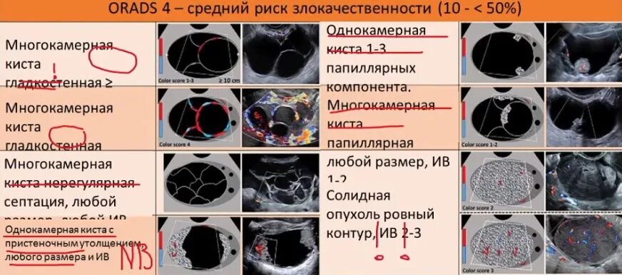 Киста o rads. Классификация o-rads для УЗИ. O rads классификация. O-rads классификация мрт. Plaque rads классификация.