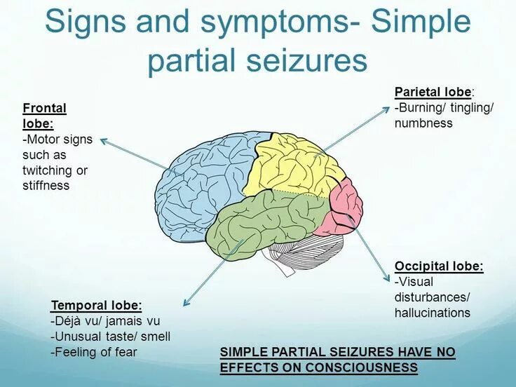 Эпилепсия 2023. Simple partial seizures).. Epilepsy Symptoms. Temporal Lobe. The causes of Epilepsy.