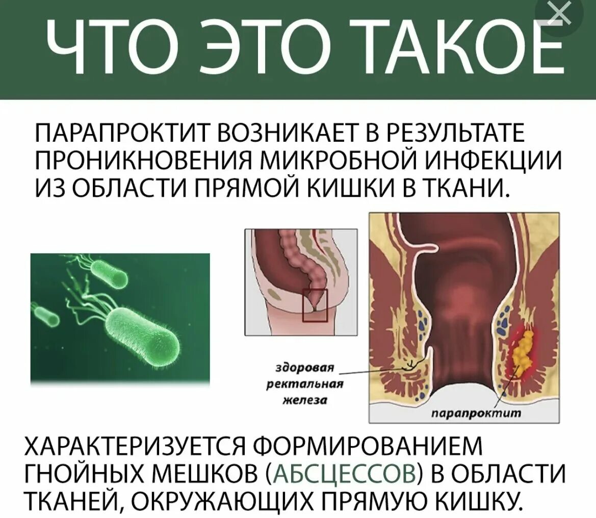 Ректальный заболевании. Воспаление параректальной клетчатки. Анаэробный парапроктит.