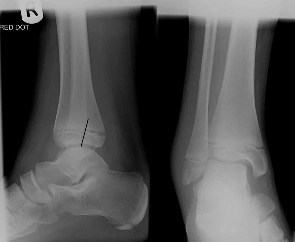 Двухлодыжечный перелом рентген. Перелом латеральной лодыжки рентген.