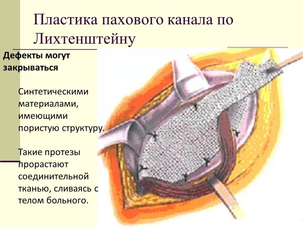 Герниопластика по Лихтенштейну. Грыжесечение герниопластика по Лихтенштейну. Пластика паховой грыжи по Лихтенштейну. Лихтенштейн операция паховая