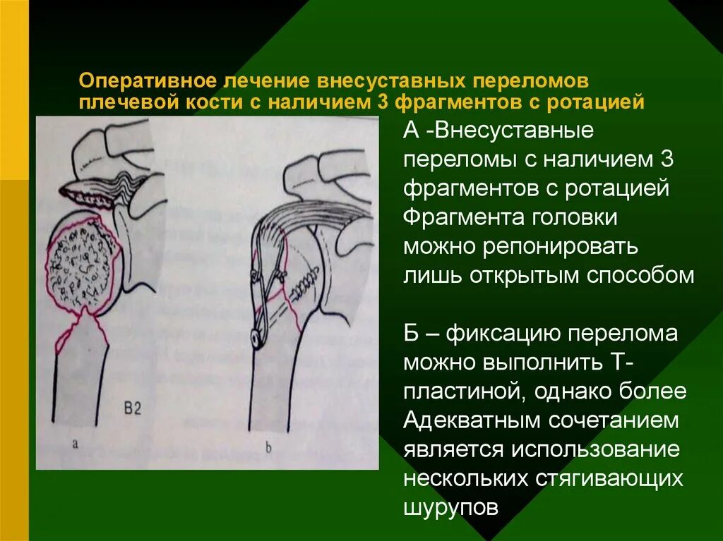 Оперативное лечение перелома костей. Перелом хирургической шейки плечевой кости. Перелом шейки плечевой кости кт. Перелом хирургической шейки плечевой кости клиника. Перелом хирургической шейки плечевой кости классификация.