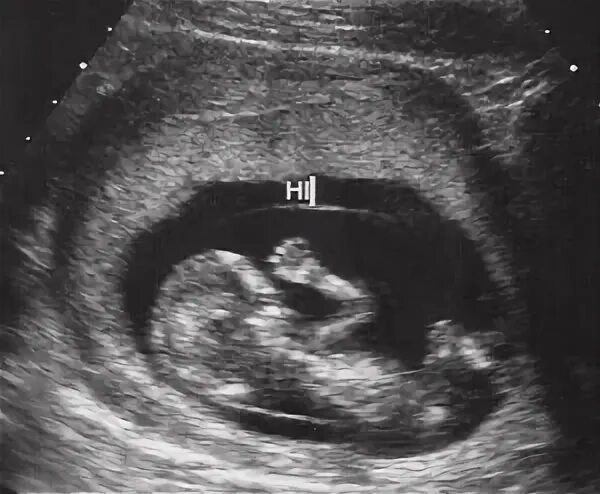 Беременность девять. УЗИ 9 недель беременности. УЗИ 10 недель беременности. УЗИ 9 недель беременности фото. Снимок УЗИ на 9 неделе беременности.
