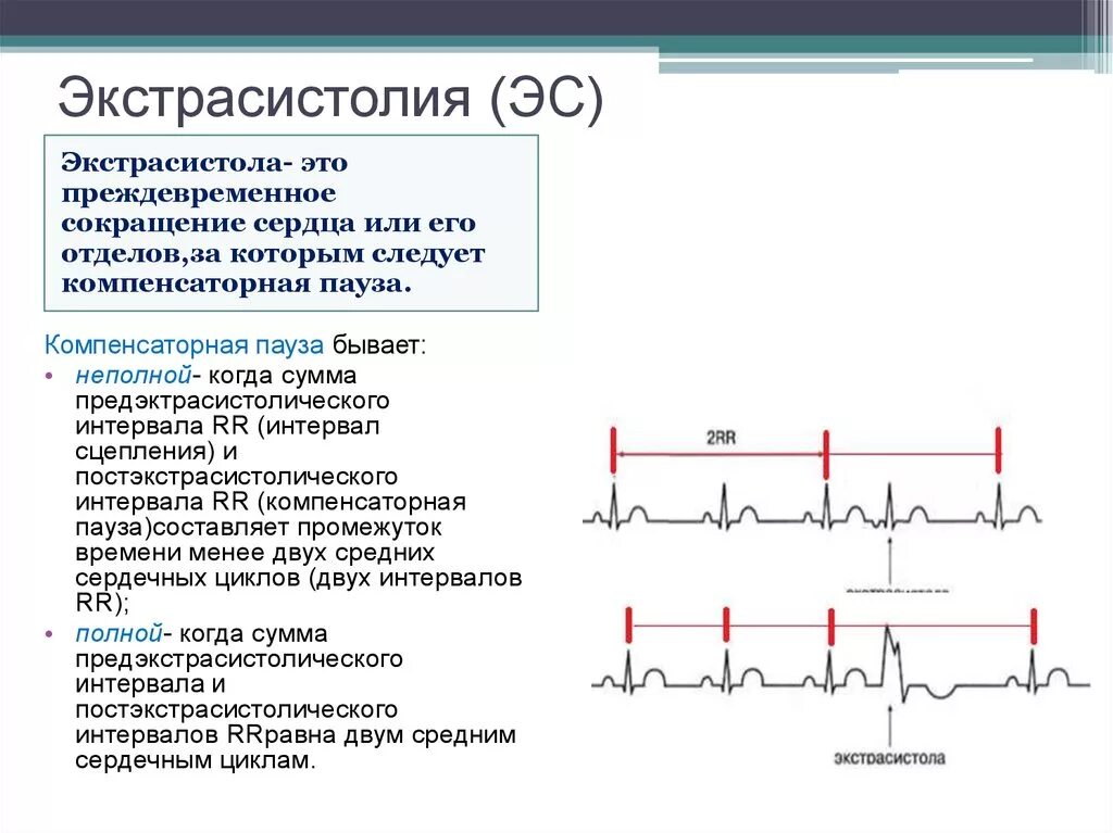 Экстрасистолы на ЭКГ. Предсердные экстрасистолы на ЭКГ. Аберрантные экстрасистолы на ЭКГ. Экстрасистолия сердца физиология. Возникновение экстрасистол