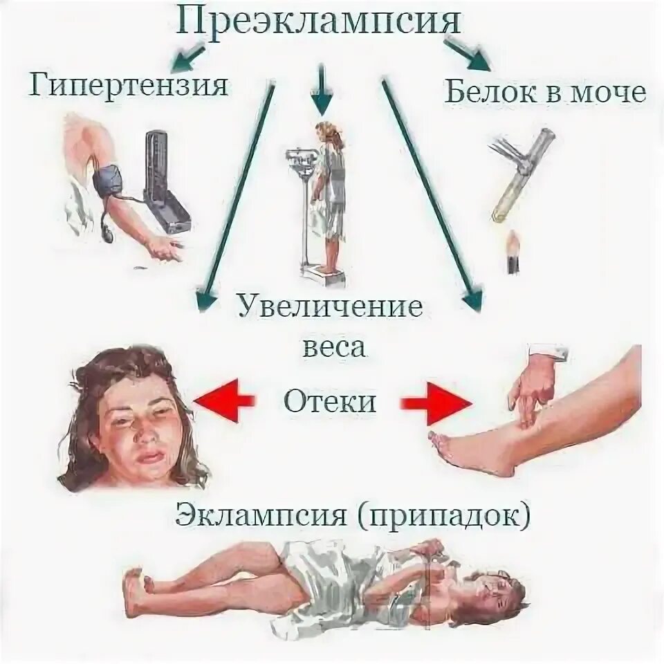 Судороги у беременных. Эклампсия судорожный синдром. судорожный припадок при эклампсии периоды. преэклампсия и эклампсия беременных. признаки эклампсии.