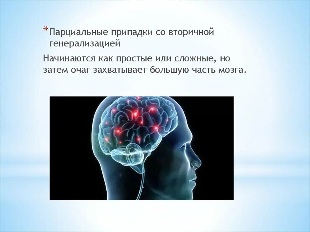 Парциальные припадки. Парциальные эпилептические приступы. Парциальные приступы эпилепсии. +Парциальные припадки с вторичной генерализацией. Простые припадки