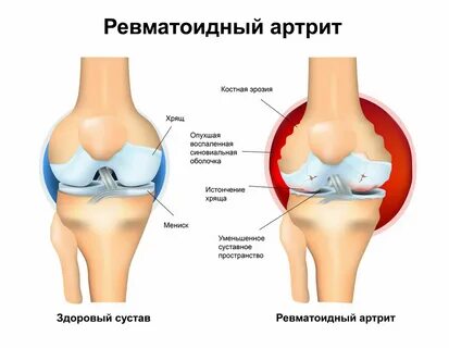 Ревматоидный артроз чем отличается