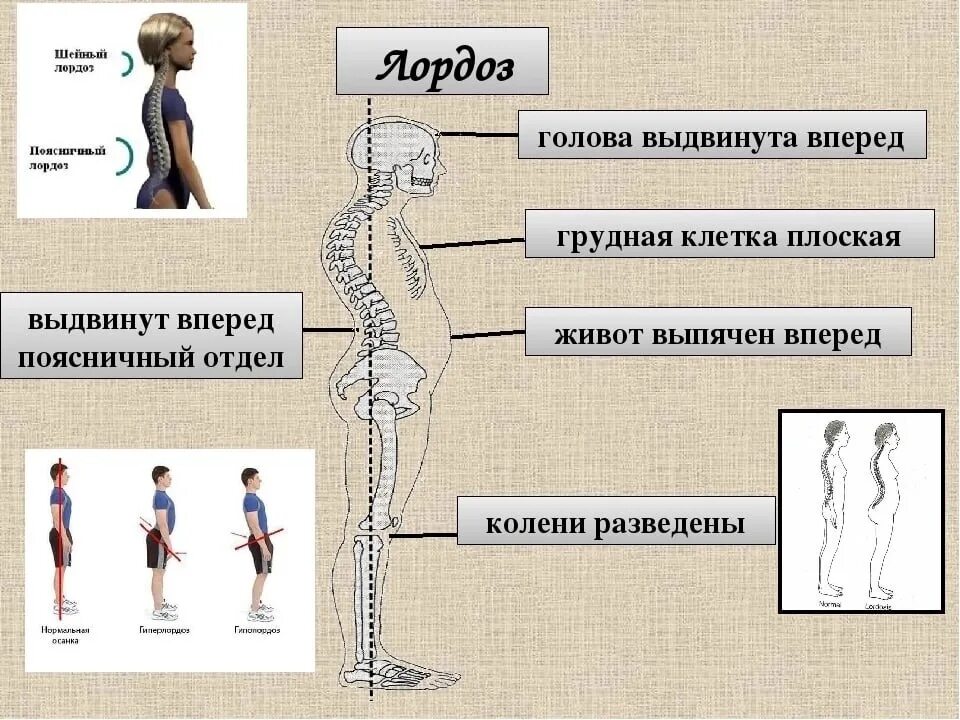 Типы осанки человека лордоз. Нарушение осанки лордоз. Поясничный лордоз. Правильный лордоз поясничного отдела.