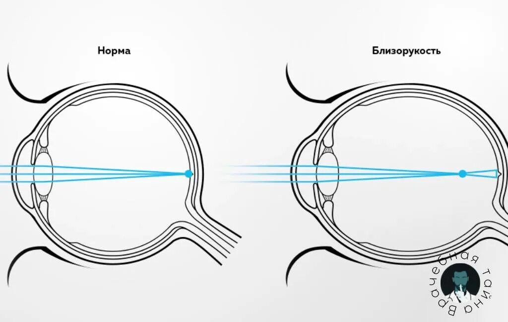 Фокусировка глаза человека. Схема строения глазного яблока при близорукости. Дальнозоркость глазное яблоко удлинённой формы. Миопия гиперметропия астигматизм. Глаз при близорукости и нормальном зрении.