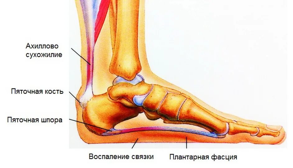 Димексидом голеностопный сустав. Пяточная шпора ахиллова сухожилия. Подошвенный (плантарный) фасциит. Строение пятки пяточная шпора.