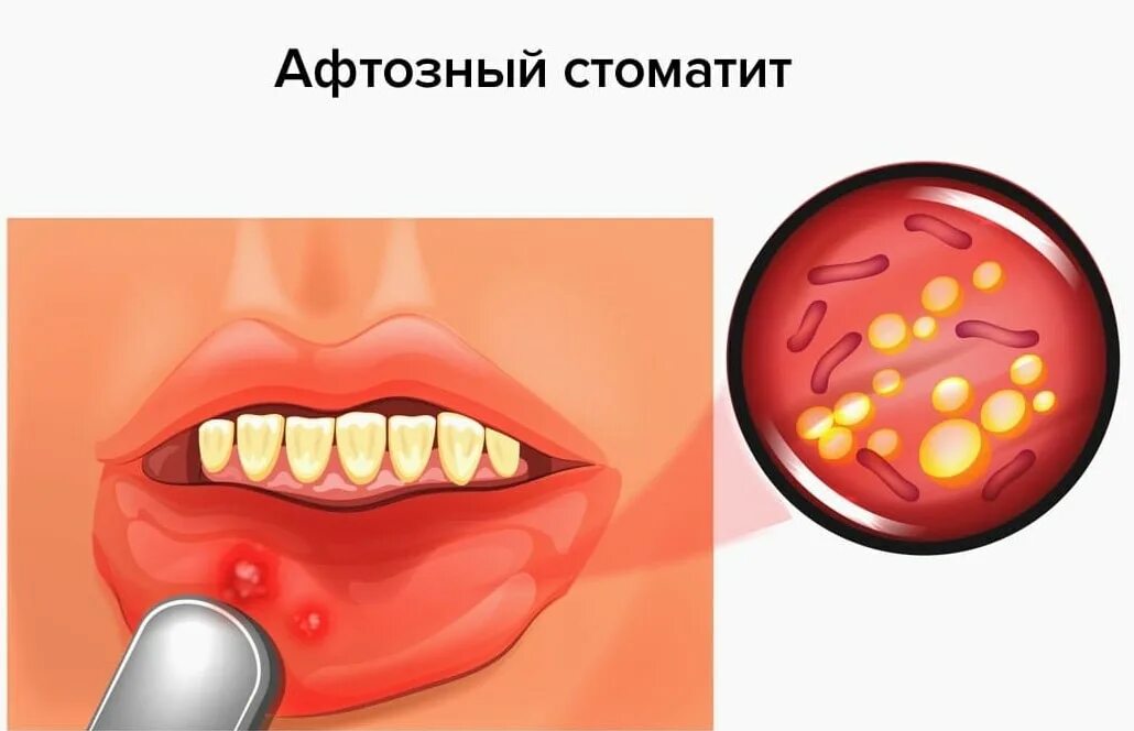 Стоматит лечение быстро и эффективно. Афтозный (бактериальный) стоматит. афтозный и язвенный стоматит. десквамативный стоматит.