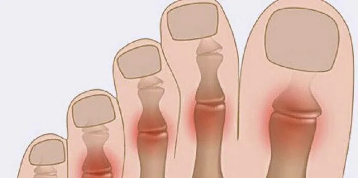 Остеома ногтевой фаланги 1 пальца стопы. При воспалении большого пальца на ноге. Болит подушечка большого пальца на ноге.