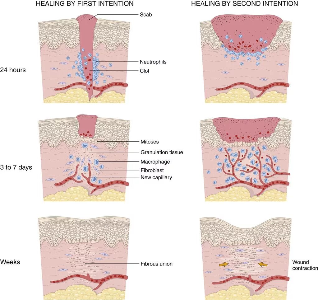 Через сколько заживает рана. Заживление РАН. Фазы заживления РАН. Схема процесса заживления раны. Фазы заживления резаной раны.